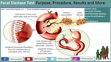 elastaza pancreatica in materii fecale|ELASTASE PANCREÁTICA